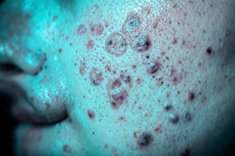 Close-up de um rosto com acne, mostrando a textura da pele e lesões como cravos e espinhas.