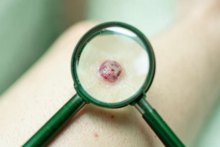 Lupa examinando uma pinta na pele, detalhe, luz focada vinda da lateral, sem ação.