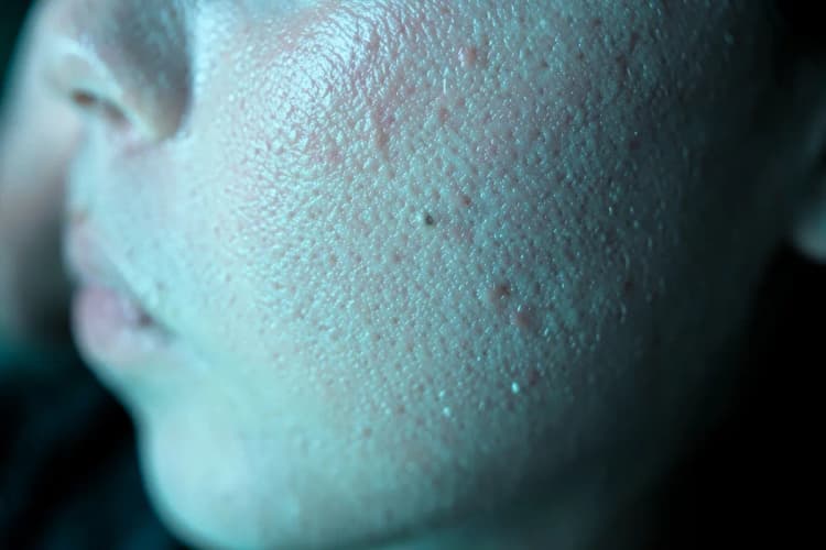 Pele limpa e saudável, sem sinais de acne ou inflamação, com um brilho natural.