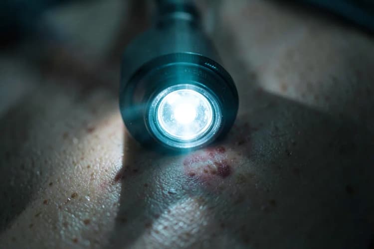 Um dermatoscópio sendo usado para examinar uma pinta suspeita na pele.