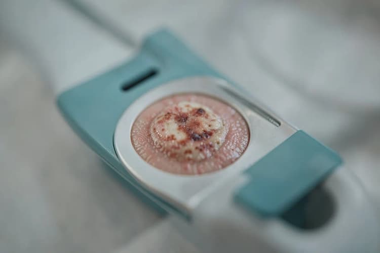 Um dermatoscópio mostrando uma lesão de pele suspeita em close-up.